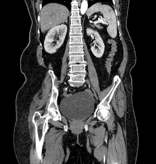 Aortoiliac occlusive disease (Radiopaedia 52352-58248 B 42).jpg