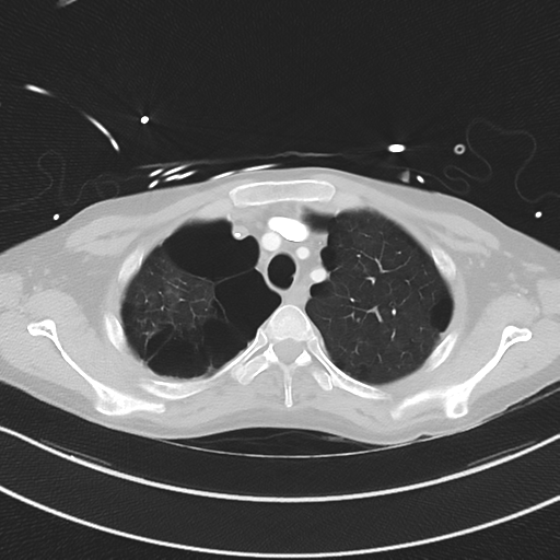 Apical bullous disease in a heavy smoker (Radiopaedia 33067-34092 Axial lung window 14).png