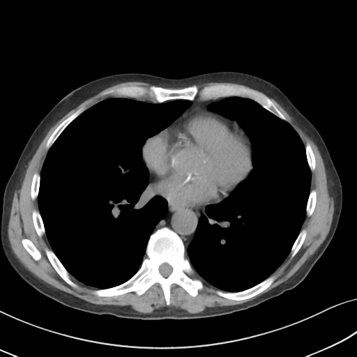 Apical pulmonary metastasis (Radiopaedia 46338-50754 B 39).png