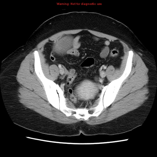 File:Appendiceal mucinous cystadenoma (Radiopaedia 8263-9111 Axial liver window 65).jpg