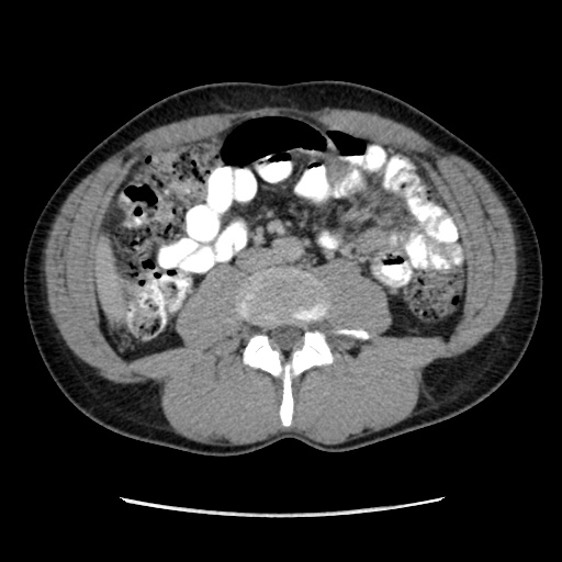 Appendicitis complicated by post-operative collection (Radiopaedia 35595-37113 A 39).jpg
