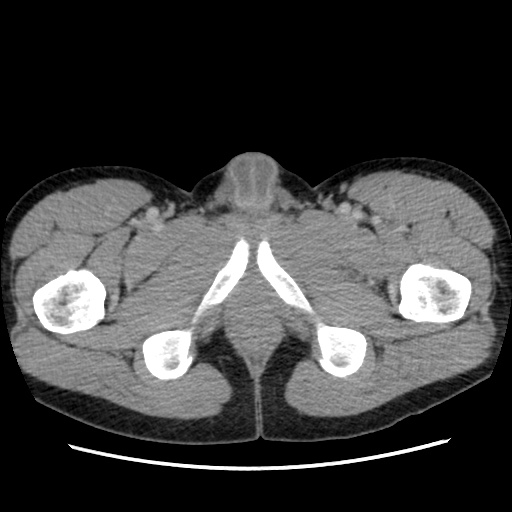 File:Appendicitis complicated by post-operative collection (Radiopaedia 35595-37114 A 93).jpg