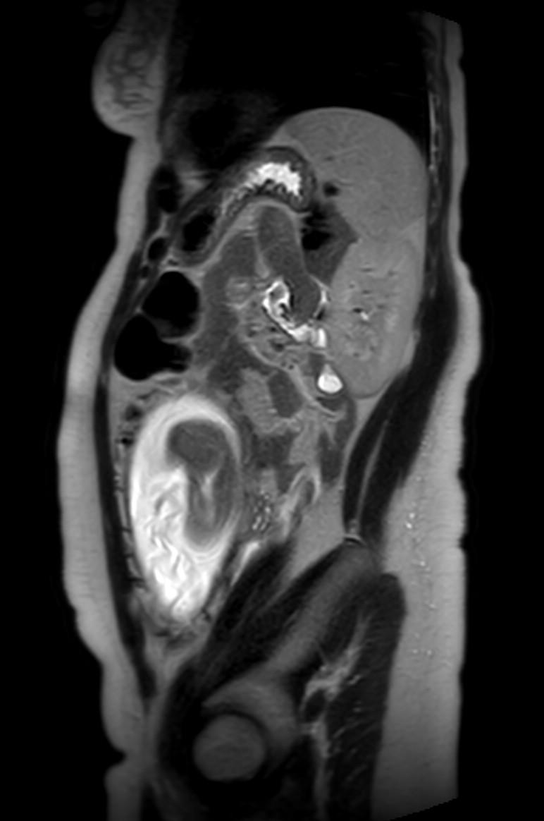 Appendicitis in gravida (MRI) (Radiopaedia 89433-106395 Sagittal T2 19).jpg