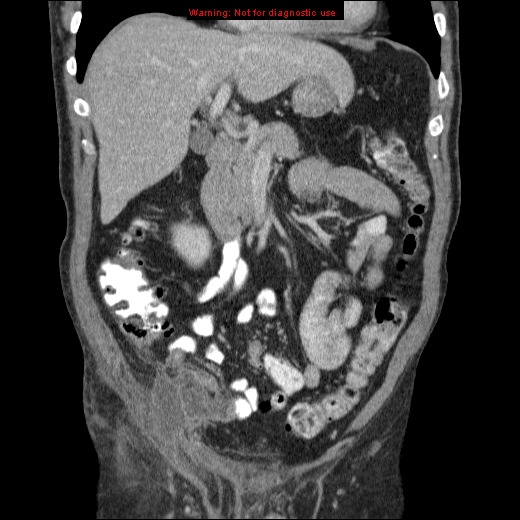 File:Appendicitis mass in inguinal hernia (Radiopaedia 26858-27029 B 24).jpg