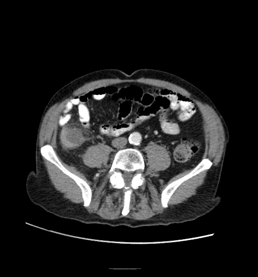 Appendicitis with localized perforation and abscess formation (Radiopaedia 49035-54130 A 58).jpg