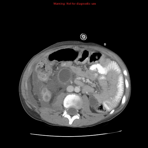 Appendicitis with phlegmon (Radiopaedia 9358-10046 A 36).jpg