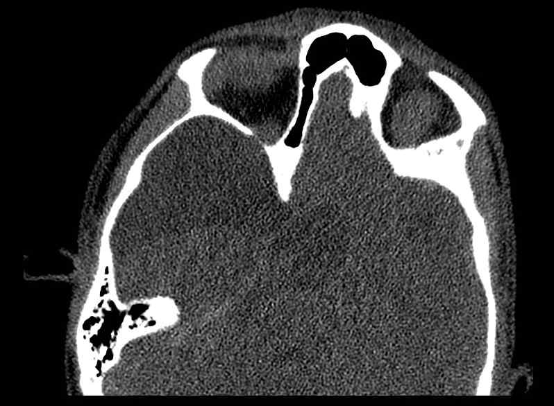 File:Arachnoid cyst- extremely large (Radiopaedia 68741-78450 Axial bone window 33).jpg