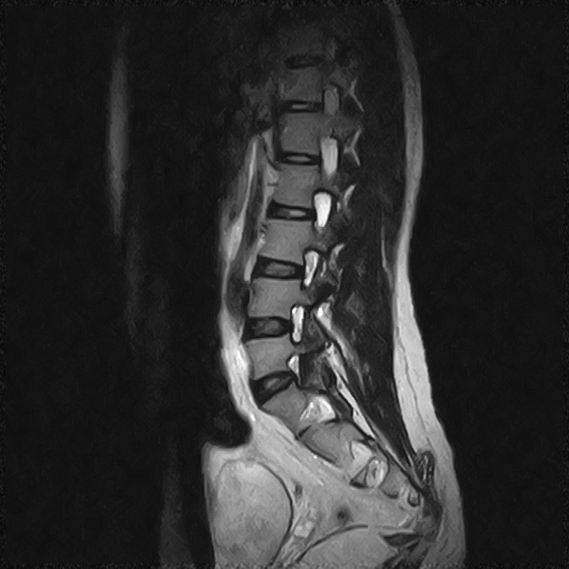File:Arachnoid cyst - spinal (Radiopaedia 66835-76157 Sagittal T2 3).jpg