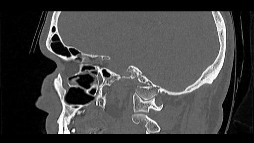 Arcuate foramen (Radiopaedia 89833-106944 Sagittal bone window 27).jpg