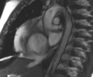 Arrhythmogenic right ventricular cardiomyopathy (Radiopaedia 69431-79307 Short axis cine 257).jpg