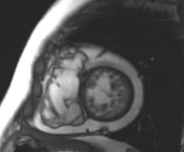 File:Arrhythmogenic right ventricular cardiomyopathy (Radiopaedia 69431-79307 Short axis cine 63).jpg