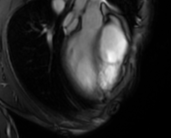 Arrhythmogenic right ventricular cardiomyopathy (Radiopaedia 69564-79464 4ch cine 17).jpg