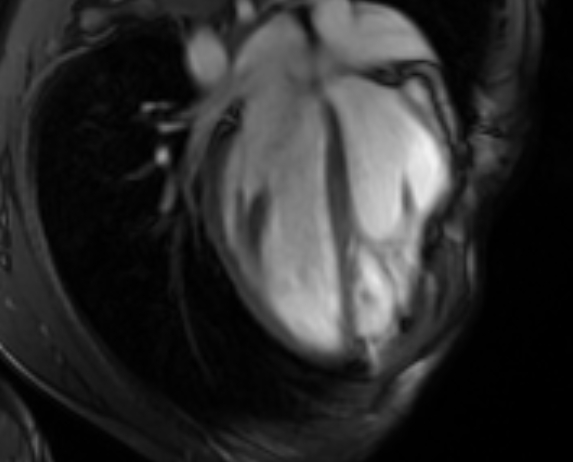 Arrhythmogenic right ventricular cardiomyopathy (Radiopaedia 69564-79464 4ch cine 55).jpg