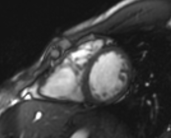 Arrhythmogenic right ventricular cardiomyopathy (Radiopaedia 69564-79464 short axis cine 112).jpg