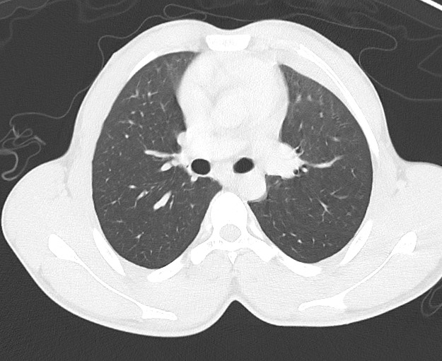 Arrow injury to the chest (Radiopaedia 75223-86321 Axial lung window 28).jpg