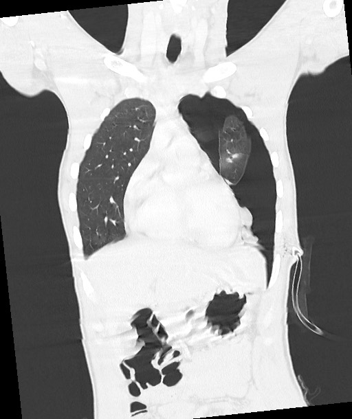 Arrow injury to the chest (Radiopaedia 85367-100975 Coronal lung window 57).jpg