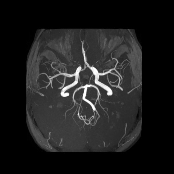 Artery of Percheron infarct (Radiopaedia 40966-43676 F 26).jpg