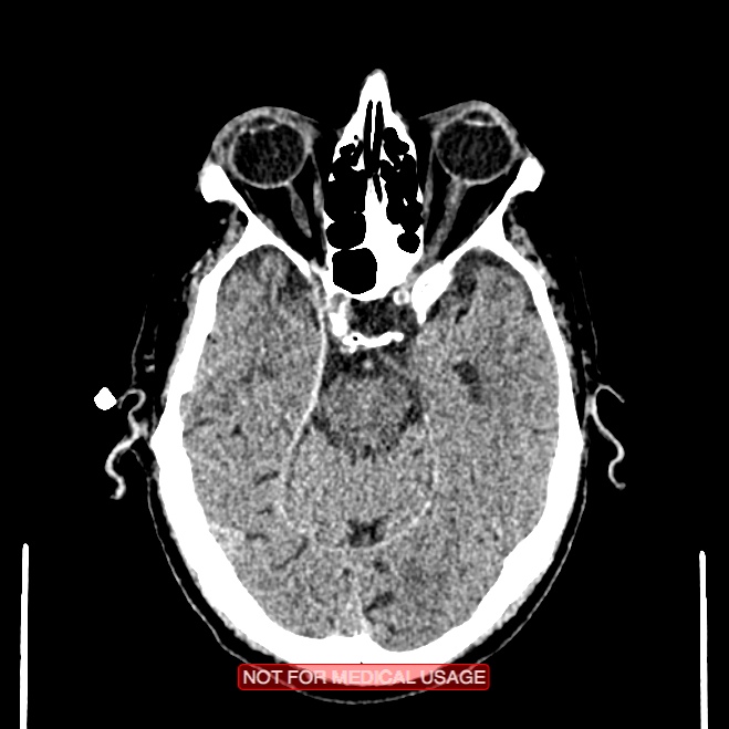 Artery of Percheron infarction (Radiopaedia 28679-28967 Axial non-contrast 42).jpg