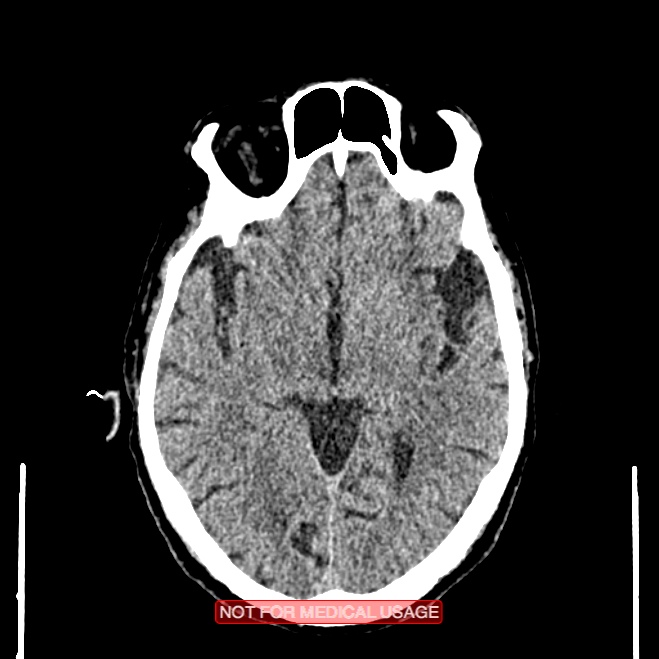 Artery of Percheron infarction (Radiopaedia 28679-28967 Axial non-contrast 55).jpg