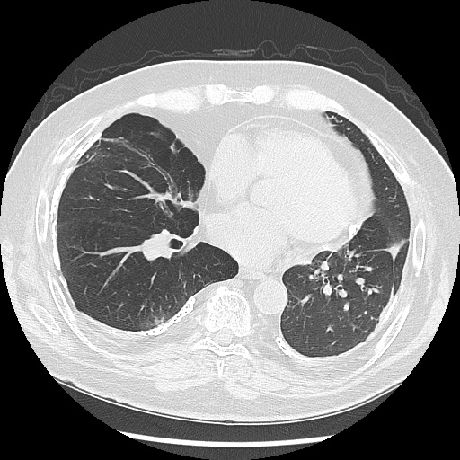 Asbestos-related pleural disease (Radiopaedia 74366-85250 Axial lung window 71).jpg