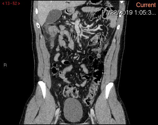 File:Ascending colonic diverticulum mimicking acute appendicitis (Radiopaedia 69943-80198 B 52).jpg