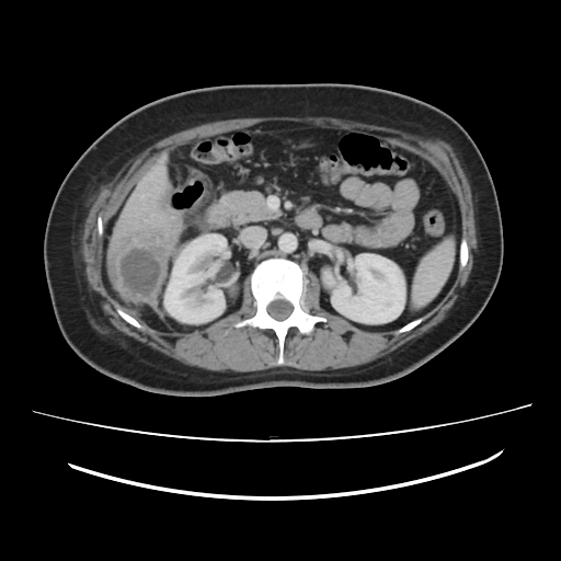 Ascending retrocecal appendicitis with liver abscesses (Radiopaedia 60066-67615 B 38).jpg