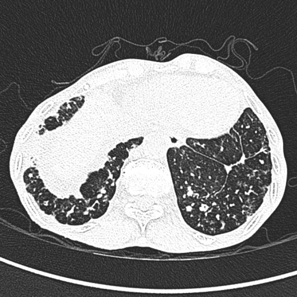 Aspergilloma- with Monod sign (Radiopaedia 44737-48532 Axial lung window 258).jpg