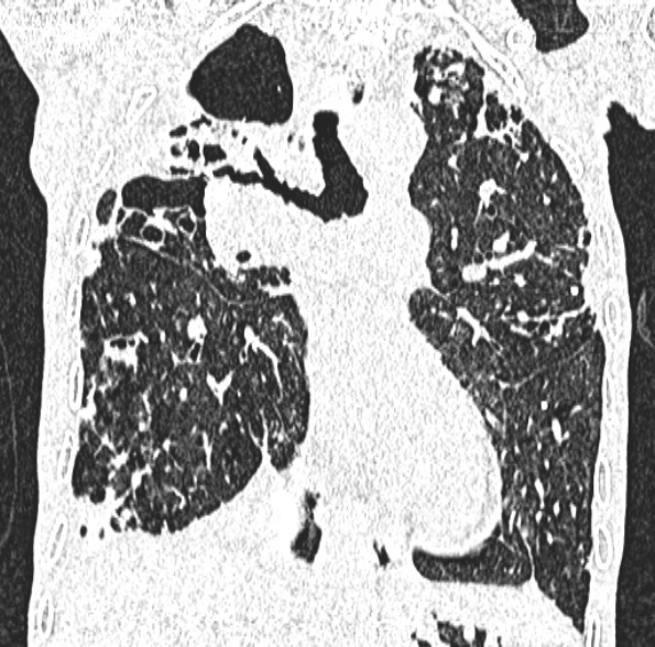Aspergilloma- with Monod sign (Radiopaedia 44737-48532 Coronal lung window 239).jpg