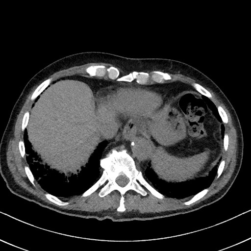 Aspergilloma on background pulmonary fibrosis (Radiopaedia 60942-68757 Axial non-contrast 47).jpg