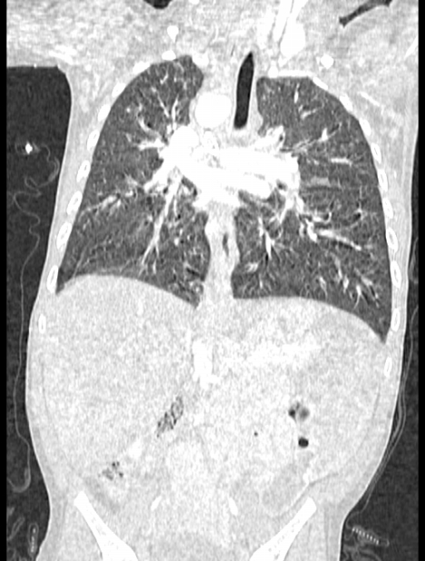 Asplenia syndrome (Radiopaedia 73083-83792 Coronal lung window 80).jpg