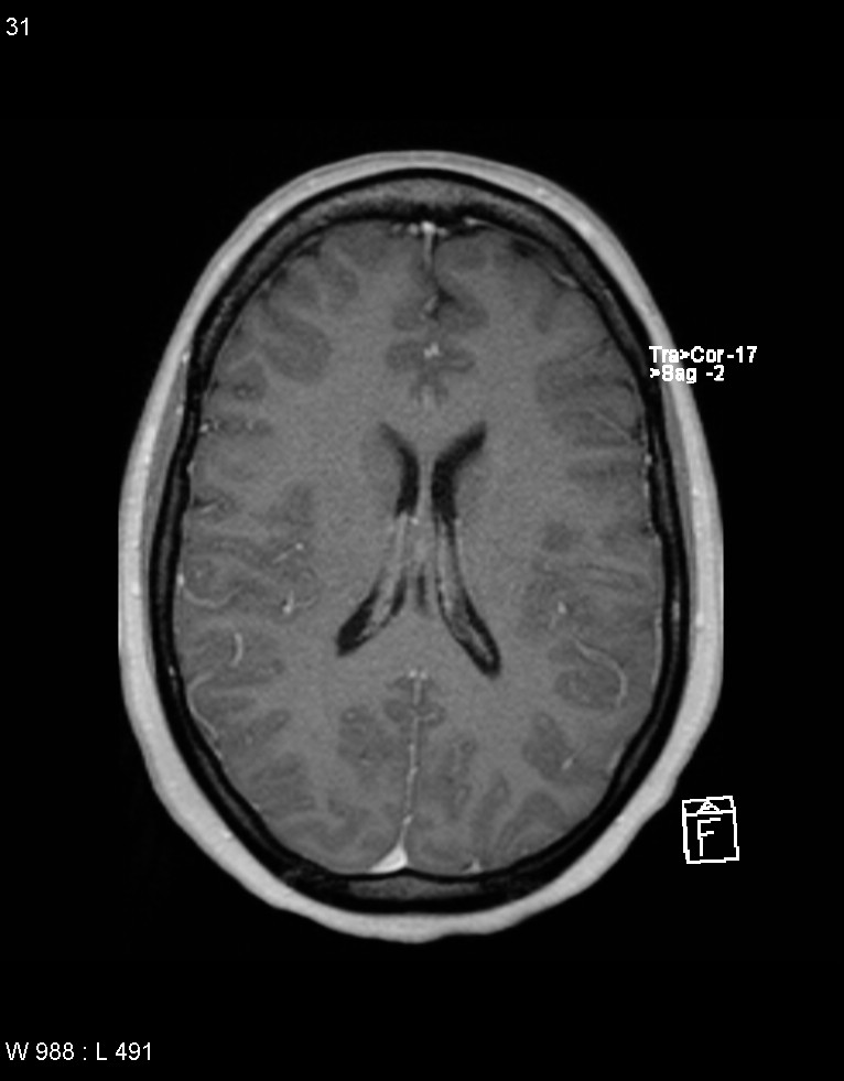 Astroblastoma (Radiopaedia 39792-42217 Axial T1 C+ 30).jpg