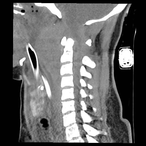 File:Atlanto-occipital dislocation (Radiopaedia 44648-48412 A 16).jpg