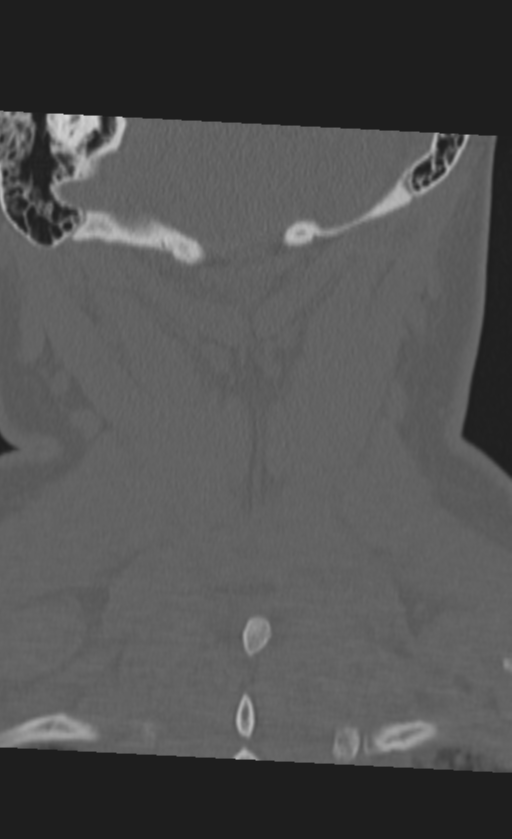 Atlanto-occipital dissociation (Radiopaedia 33848-35013 Coronal bone window 47).png