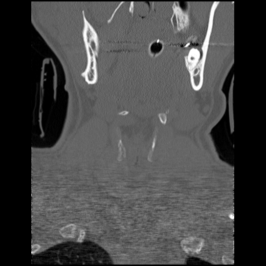 Atlanto-occipital dissociation injury (Radiopaedia 29274-29698 Coronal bone window 49).png