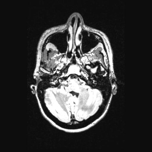 Atretic encephalocoele with inferior vermis hypoplasia (Radiopaedia 30443-31108 Axial 40).jpg
