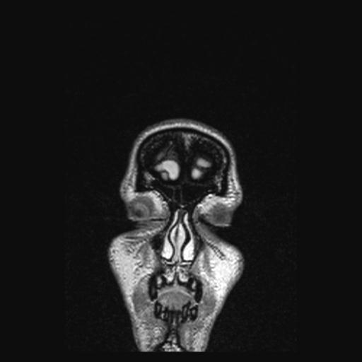 Atretic encephalocoele with inferior vermis hypoplasia (Radiopaedia 30443-31108 Coronal FLAIR 172).jpg