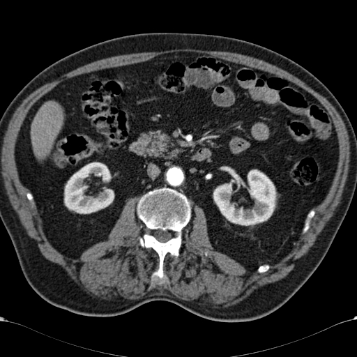Atypical hepatocellular carcinoma (Radiopaedia 41744-44698 A 50).jpg