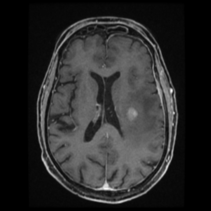 Atypical meningioma (Radiopaedia 45535-49629 Axial T1 C+ 42).jpg