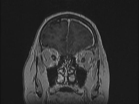 Atypical meningioma (Radiopaedia 62985-71406 Coronal T1 C+ 18).jpg