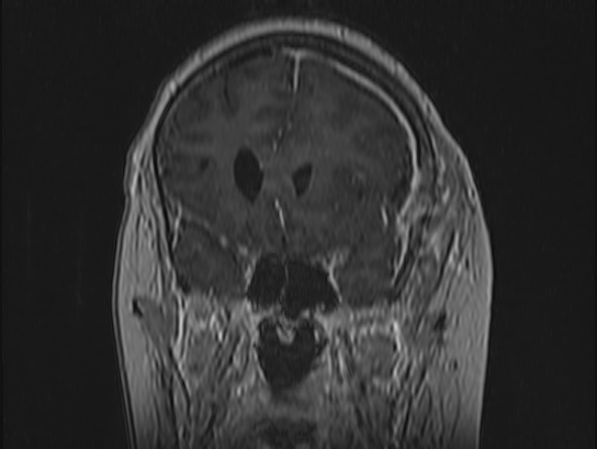 Atypical meningioma (Radiopaedia 62985-71406 Coronal T1 C+ 35).jpg