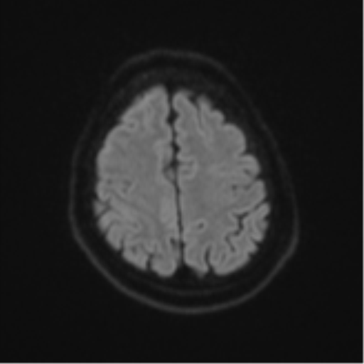 Atypical meningioma (WHO Grade II) (Radiopaedia 54742-60979 Axial DWI 50).png