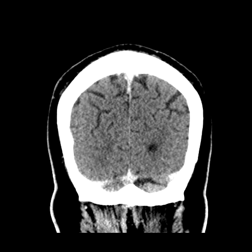 Atypical meningioma (WHO grade II) with brain invasion (Radiopaedia 57767-64728 Coronal C+ 54).png