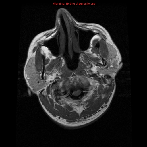 File:Atypical meningioma - grade II (Radiopaedia 13303-13305 Axial T1 1).jpg