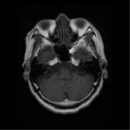 File:Atypical meningioma with skull invasion (Radiopaedia 34357-35648 Axial T1 5).png