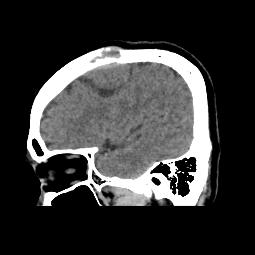 Atypical meningioma with skull invasion (Radiopaedia 34357-35649 E 13).png