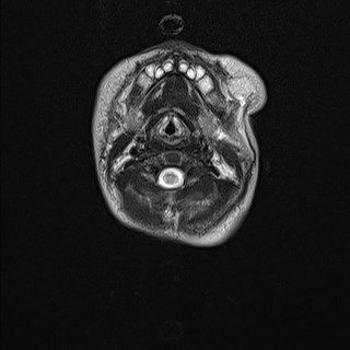 File:Atypical teratoid rhabdoid tumor (prenatal US and neonatal MRI) (Radiopaedia 59091-66388 Axial T2 2).jpg