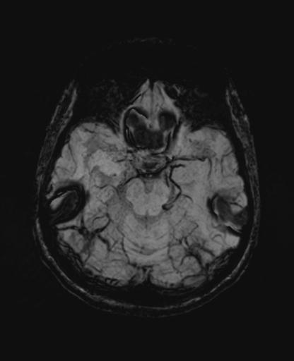 Autoimmune limbic encephalitis (Radiopaedia 30363-31005 SWI - mIP 25).jpg