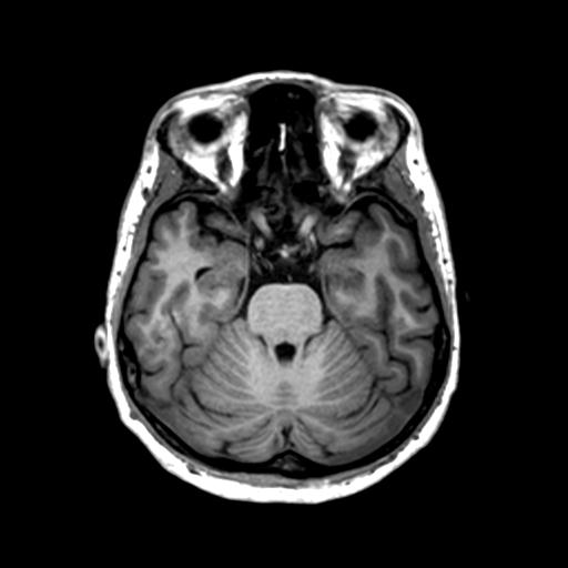 File:Autoimmune limbic encephalitis (Radiopaedia 30363-31005 T1 Axial 1mm 53).jpg