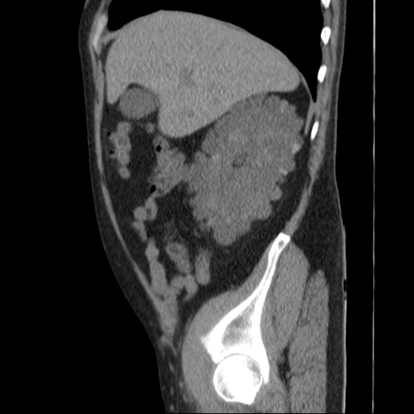 Autosomal dominant polycystic kidney disease (Radiopaedia 36539-38101 D 22).jpg