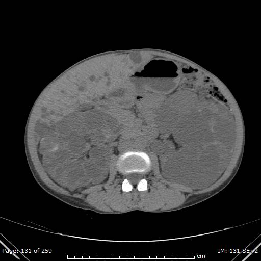 File:Autosomal dominant polycystic kidney disease (Radiopaedia 44122-47684 Axial non-contrast 47).jpg